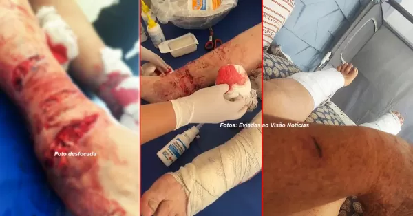 Mulher fica gravemente ferida ao ser atacada por pitbull em Marília. É o segundo caso em cinco horas