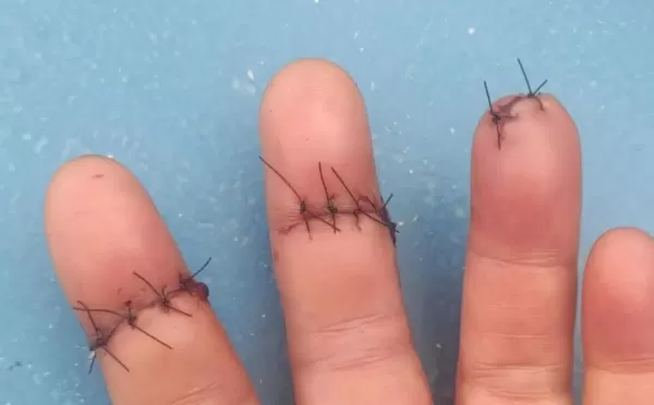 Motociclista sofre cortes graves após ser atingida por linha com cerol