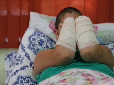 Mulher tem as mãos e pés decepados por marido