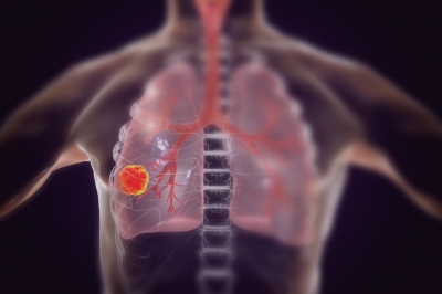Campanha Agosto Branco: mais de 80% dos casos de câncer de pulmão estão relacionados ao tabagismo