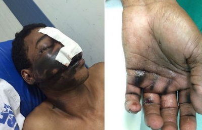 Homem fica ferido com explosão de celular durante conversa