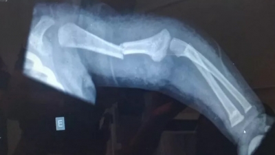 Pai é preso acusado de quebrar braço da filha de três meses 