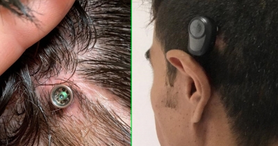 Médica da Santa Casa faz implante ósseo e paciente recupera audição bilateral