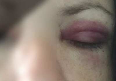 Enfermeira posta foto após ser agredida pelo marido: 