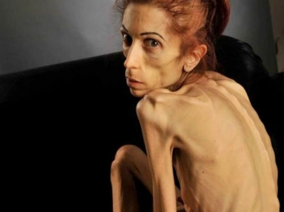 Mulher que pesava 18 kg mostra recuperação pós-anorexia bancada com doações online