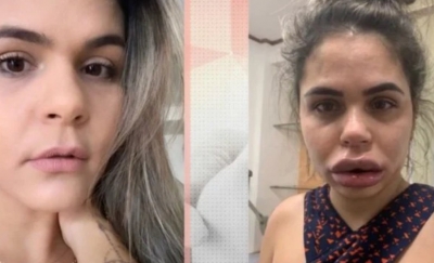 Dentista é acusada de deformar rosto de mulheres após harmonização facial