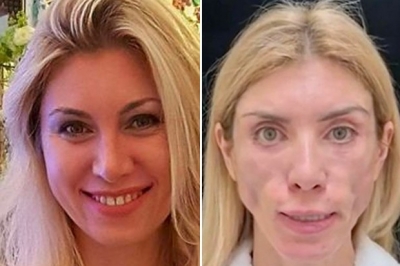 Após cirurgia plástica miss não consegue fechar os olhos e nem sorrir