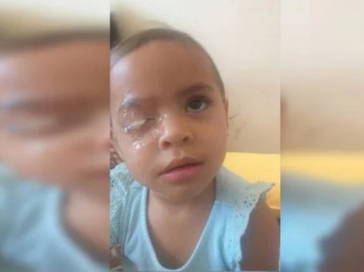 Menina de 2 anos que passou Super Bonder no olho passará por cirurgia