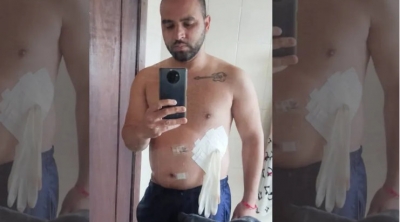 Médico coloca luva cirúrgica no lugar de bolsa de colostomia em paciente