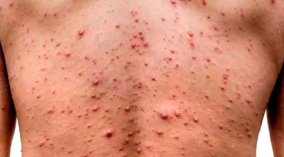 Prefeitura de Tupã alerta para surto de catapora em escolas municipais