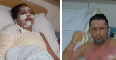 Família se queima ao usar álcool para cozinhar por falta de gás e pede ajuda