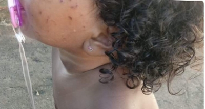 Prefeitura de Marília é condenada a indenizar em R$ 5 mil família de criança arranhada em creche