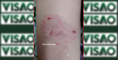 Menino de 11 anos é atacado por cães ao sair de escola em Marília