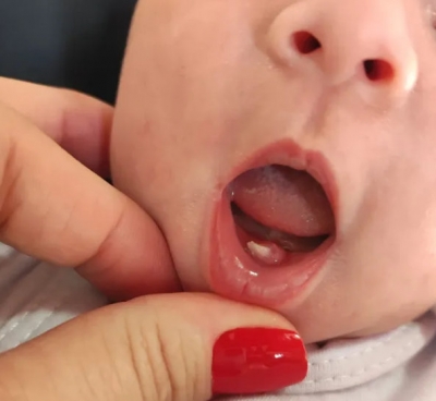 Bebê surpreende família ao nascer com ‘dentinho’ 