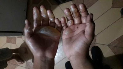 Mãe é suspeita de queimar mãos de filho de 9 anos com ferro de passar