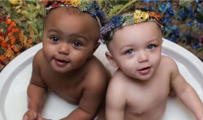 As primeiras gêmeas do planeta com diferentes cores da pele já são adultas: veja como estão hoje