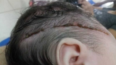 Recém-nascida é cortada na cabeça com bisturi durante parto