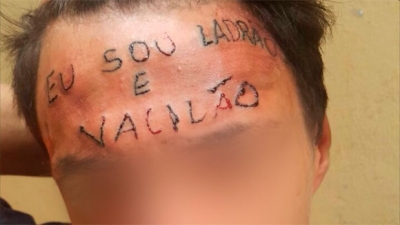Rapaz tatuado na testa passa pela primeira sessão para remover frase 
