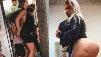 Mulher com bumbum de 2 metros diz sentir falta dos antigos glúteos