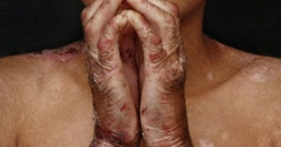 Pacientes com epidermólise bolhosa terão protocolo de cuidados