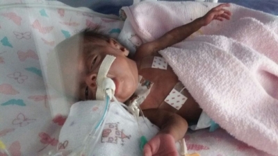 Bebê que nasceu com 340 gramas tem alta após 10 meses