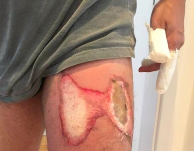 Celular pega fogo no bolso da calça e deixa homem com queimaduras 