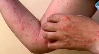 Região tem primeiro caso suspeito de varíola dos macacos