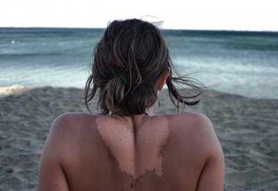 Pele descascando de sol? Veja como cuidar e como evitar manchas neste verão