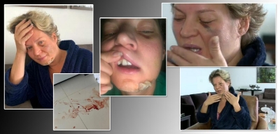 Joice Hasselmann tem diversas fraturas no rosto e corpo, mas não se lembra do que houve