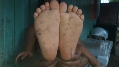 Criança de 3 anos é vítima de maus-tratos ao apanhar com cipó e ter os pés furados