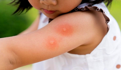 Cuidado com as reações do corpo às picadas de inseto