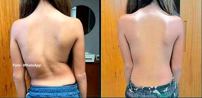 Família comemora sucesso de cirurgia para corrigir coluna de adolescente em Marília