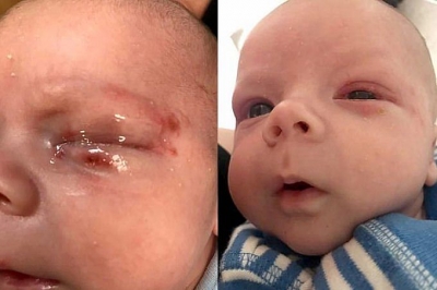 Alerta: bebê quase morre por herpes no olho contraída através de beijo