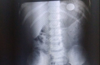 Criança engole moeda e pode precisar de cirurgia para retirá-la