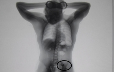 Raio-x de presídio acha alianças engolidas por assaltante e joias são devolvidas