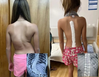Mariliense de 12 anos dá primeiros passos após cirurgia de correção da coluna