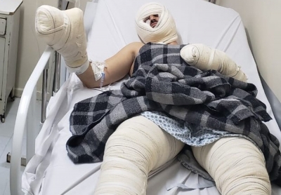 Vítimas de explosão fazem cirurgia nesta segunda. Menino de 11 anos morreu 