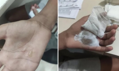 Mãe e madrasta queimam menino com colher quente por ele pegar moeda pra comprar doce