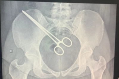 Mulher fica 2 meses com pinça esquecida dentro do corpo após cirurgia