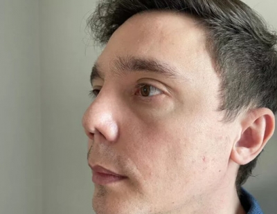 Polícia investiga cirurgião plástico suspeito de deformar nariz de pacientes