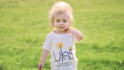 Doença rara faz menina ter cabelo igual ao de Einstein