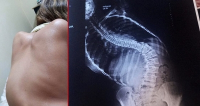 Mariliense vende bolos para conseguir pagar cirurgia de R$ 150 mil da filha