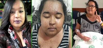 Família faz campanha para ajudar jovem com doença rara em Marília