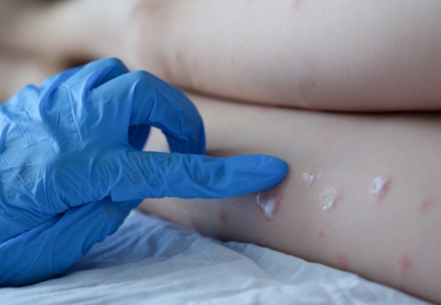 Primeiro caso de varíola dos macacos no Brasil é confirmado na cidade de SP
