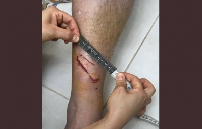 Turista francês é atacado por tubarão em Ubatuba, litoral de São Paulo