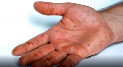 Estado lança plano de enfrentamento à varíola dos macacos