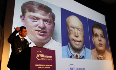 Bombeiro recebe maior transplante de rosto já realizado