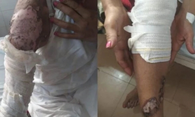 Mulher é jogada em fogueira de festa junina por amante do marido