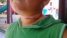 Criança corta o pescoço                       com linha de cerol