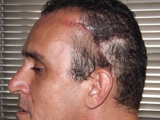 Homem que teve faca cravada     na cabeça fará 